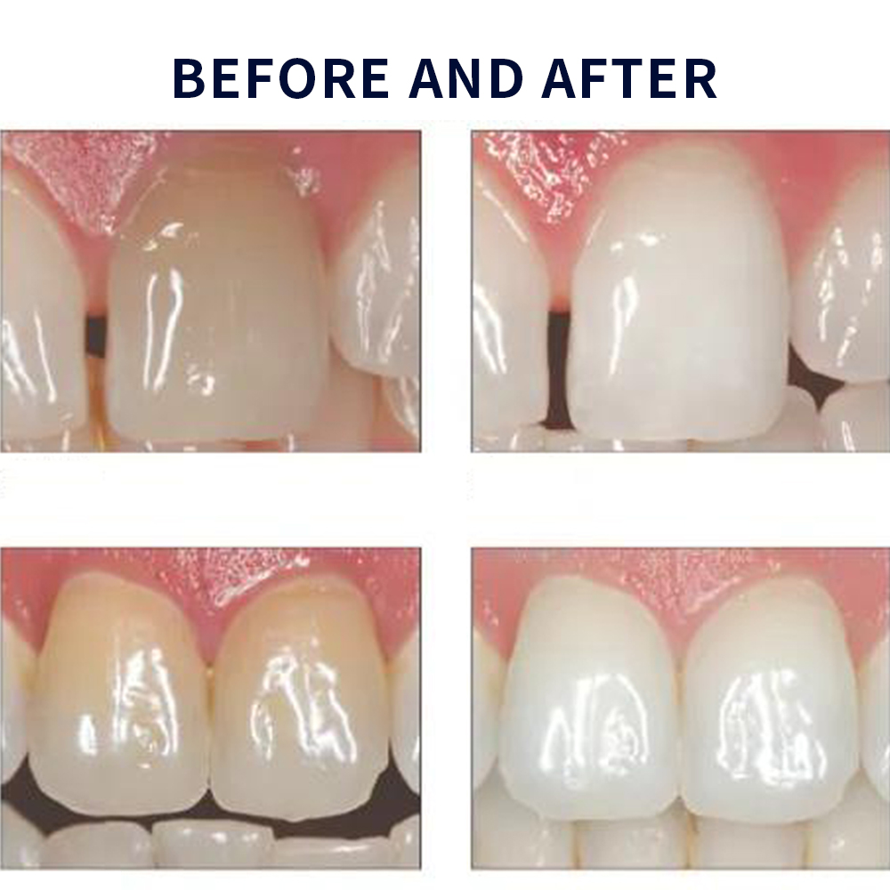 Opalescence Whitening 20% PF 2 - Teeth Whitening Singapore ulasan dan harga