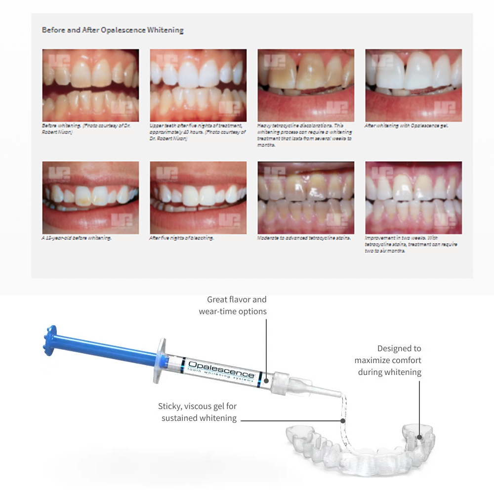 Opalescence Whitening 20% PF 2 - Teeth Whitening Singapore ulasan dan harga