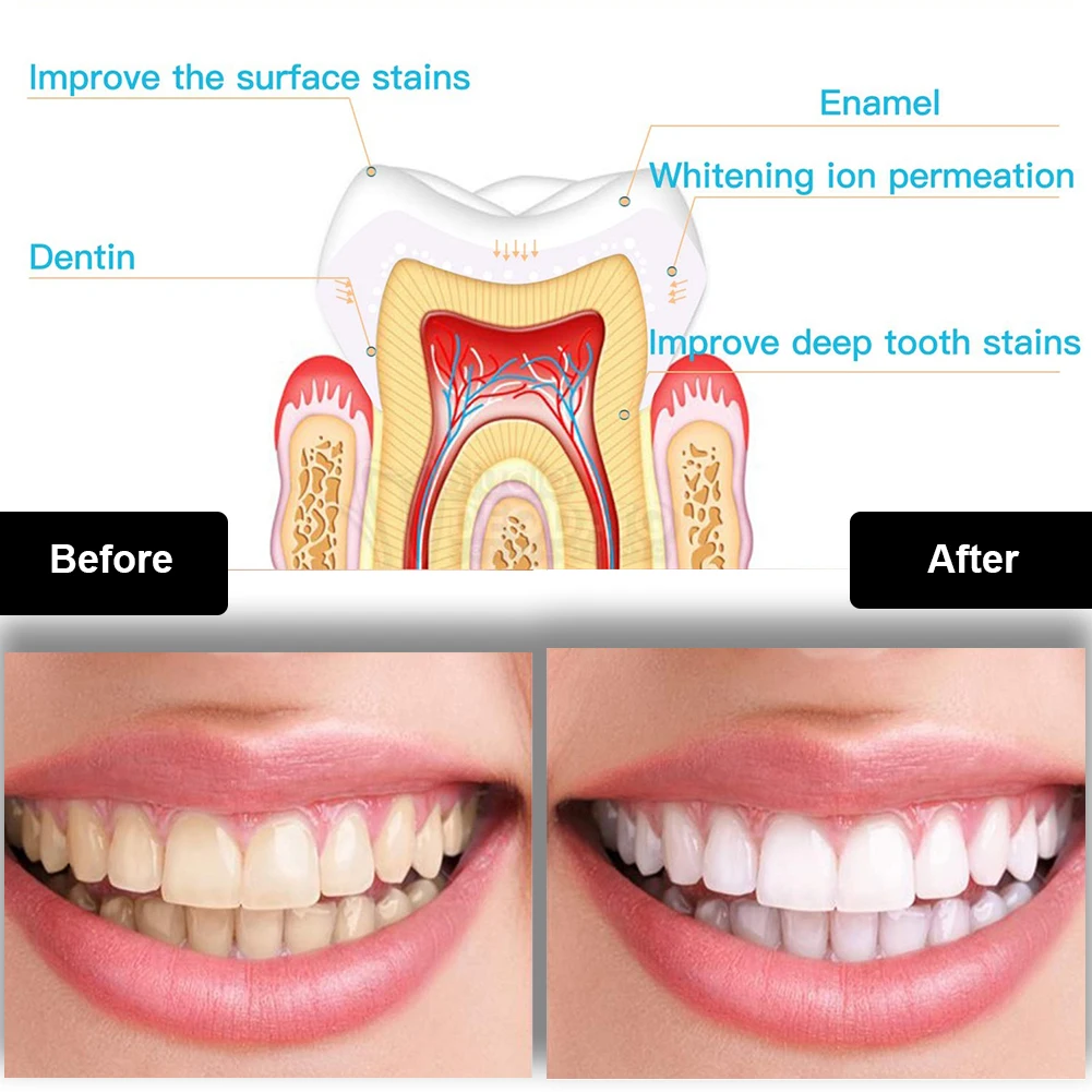 Dental Teeth Whitening Kit Min - Teeth Whitening Singapore ulasan dan harga